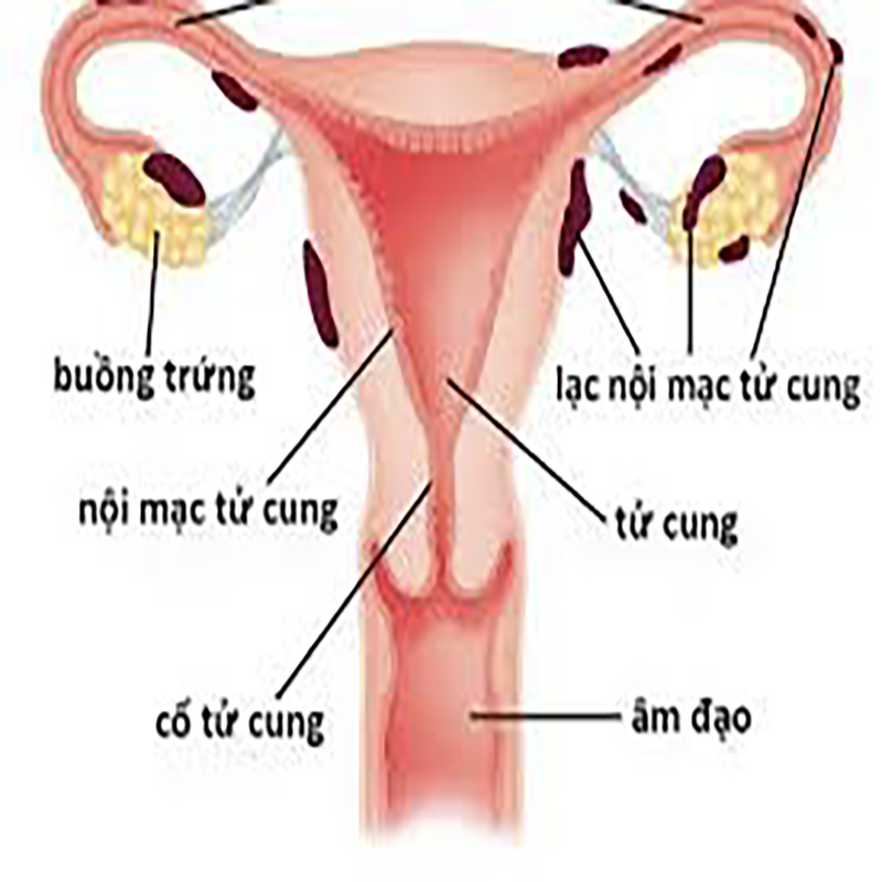 Lạc nội mạc tử cung