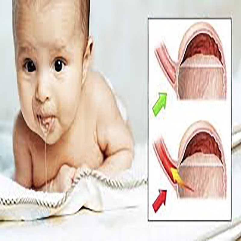 trào ngược dạ dày