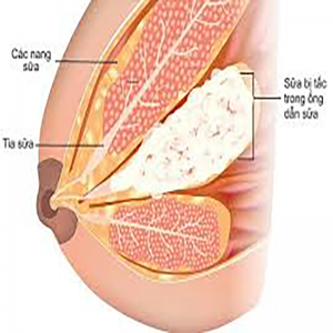 căng nhức do tắc sữa